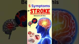 5 Symptoms of Stroke Beware of this [upl. by Compton]