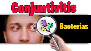 Conjuntivitis Bacteriana  Como identificarla SINTOMAS y tratamiento [upl. by Mccowyn]