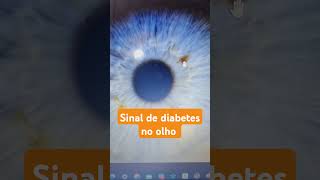 Sinal de diabetes no olho terapiasnaturais olhos iris iris diabetes iridologia ibrin acucar [upl. by Laekim]