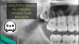 Using Pott’s Elevator to Help Extract a Maxillary Wisdom Tooth drwahan [upl. by Uuge]