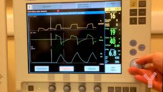 Maximum Inspiratory Pressure MIP or Negative Inspiratory Force NIF on Maquet Servoi [upl. by Dlarrej]