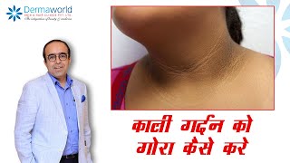 Acanthosis Nigircans Treatment  काली गर्दन को गोरा कैसे करे  In Hindi  Dr Rohit Batra [upl. by Acissev328]