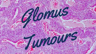 Glomus Tumours  Pathology mini tutorial [upl. by Eintruoc]