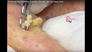 Blackheads Removal Big For Cao  Hang Oliver  Part 317 [upl. by Rednaskela770]