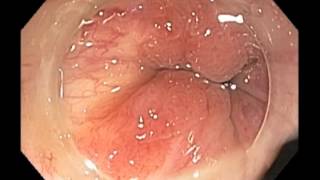 Anal canal  Cancer  Healed after chemoradiation [upl. by Eemia253]