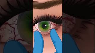 Eyes infection clinging 3D Animation ASMR Video Part2  infected eyes 🤢😷satisfying relaxing [upl. by Aciretehs810]