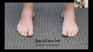 Meet the Cavus Foot  The Functional Impact of High Arches with Dr Emily [upl. by Rumit281]