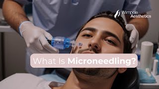 RF Aesthetics Secret  What Is Microneedling [upl. by Bricker]