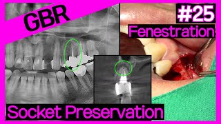 Online Surgery Socket preservation with collagenated graftAOss Collagen on damaged socket [upl. by Kissiah]