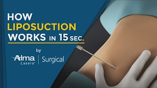 How Liposuction Works in 15 Seconds Medical Technology 3D Animation 2020 [upl. by Yr14]