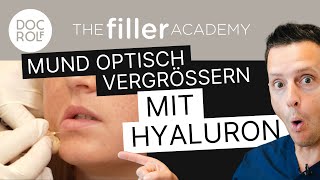 Optisch breiterer Mund durch HYALURON FILLER TFA by Dr Rolf Bartsch [upl. by Greenes484]