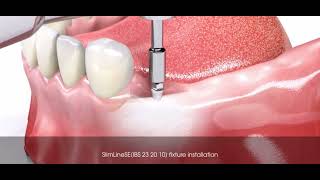 Prothèse amovible CLIPSÉ sur implant bouton pression [upl. by Ydnab]