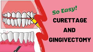 Gingival Curettage and Gingivectomy  PERIODONTOLOGY [upl. by Hallam]