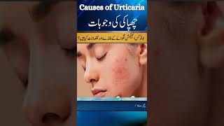 What Causes Urticaria Dr Atif Kazmi Explains Common Triggers [upl. by Heffron]