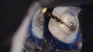 Endodontic in Ramadan  الحلقة الأولي  Diagnosis  part 1 [upl. by Jonie]