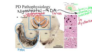 Parkinsons Disease Pathophysiology [upl. by Georgia]