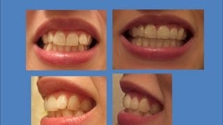 INVISALIGN Update Tray 21 last tray amp Refinements [upl. by Faust]