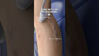 Super glue for your veins 3D Animation [upl. by Acir]