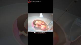 What is an amniocentesis  Amniotic fluid check up [upl. by Nibur366]