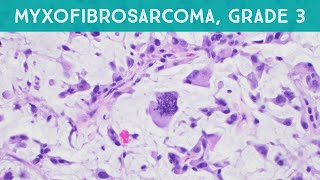 Myxofibrosarcoma grade 3 high grade pathology sarcoma dermpath dermatology dermatopathology [upl. by Llertnac]