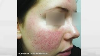 Rosacea relief How to treat persistent facial flushing [upl. by Rolandson153]