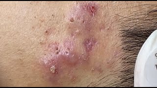 Hematoma Inflammation Acne HoangMySpa87 [upl. by Oballa]