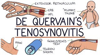 Understanding De Quervain’s Tenosynovitis Mummy Thumb [upl. by Neeoma879]