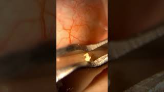 Surprising first time eyelid gland expression [upl. by Mccreary]