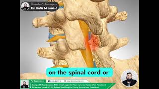 Lumbar Laminectomy Relieve Spinal Nerve Pressure  Dr Hafiz M Junaid Explains [upl. by Rance]