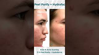 Chemical peel before and after chemicalpeels chemicalprocess melasma wrinkles acne [upl. by Rooker]