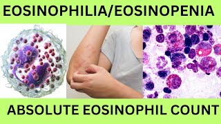 EOSINOPHILIAEOSINOPENIAABSOLUTE EOSINOPHIL COUNTAECHYPEREOSINOPHILIC SYNDROMEEOSINOPHILLEUKEMIA [upl. by Seek]