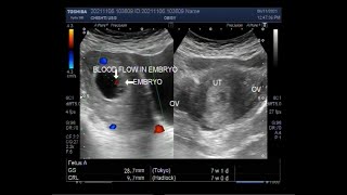 A Pregnancy of 7 weeks Ultrasound Findings [upl. by Lawry]