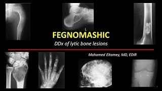 FEGNOMASHIC DDx of Lytic Bone Lesions [upl. by Unhsiv]