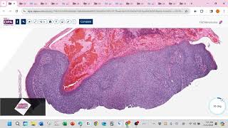 Trichilemmoma Cowden syndrome [upl. by Niveb]