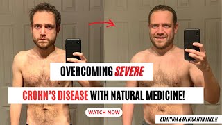 Reversing Severe Crohns Disease with Natural Medicine Watch How [upl. by Salohcim938]