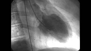 Procedural Coronary Angiography of Coronary Artery Thrombus Aspiration Followed by Bolus Intracorona [upl. by Leftwich]