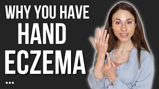 THIS IS WHY YOU HAVE HAND ECZEMA 🖐 DERMATOLOGIST DrDrayzday [upl. by Rengia]