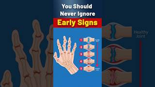 Could Arthritis Be Impacting Your Life Watch These Key Warning Signs [upl. by Laroc]