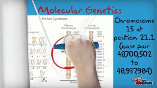 Marfans Syndrome [upl. by Eissat]