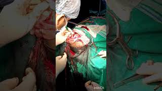 Craniotomy Procedure mbbsdairies mbbs aiimsdelhi biharmedicalcollege medico doctor [upl. by Cherrita]