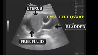 SIMPLE OVARIAN CYST RUPTURED DURING ULTRASOUND [upl. by Qidas523]