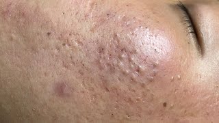 ACNE TREATMENT VU QUYNH MI  Blackheads Of Tweens 2024 EX [upl. by Eirrot]