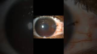 IntraocularForeignBodyCornealLacerationHyphemaIrisTearSomasundaramEyeHospitalKarur [upl. by Ahsaten507]