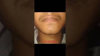 New Journey For Beard Minoxidil After Beard fall  Man Matters Beard Minoxidil  15 Month Result [upl. by Hulburt]