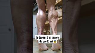 Se desgarró un gemelo y le quedó así gym gemelos fitness bodybuilding [upl. by Rexferd]