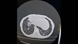 KartagenerAfzelius syndrome a subset of Primary ciliary dyskinesia [upl. by Ailec]