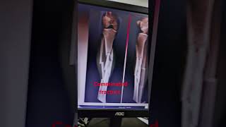 Leg fracture  comminuted fracture  tibia and fibula fracture [upl. by Sirej]