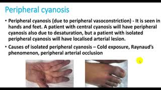 APPROACH TO CYANOSIS 4TH YR [upl. by Midge]