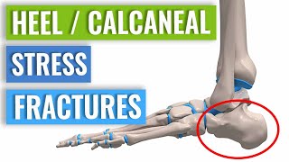 HeelCalcaneal Stress Fracture Causes Symptoms amp Treatment [upl. by Yrallam192]