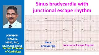 Sinus bradycardia with junctional escape rhythm [upl. by Harbard]